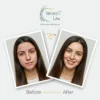 Before and after comparison of a woman’s skin using Nature’s Law skincare – from acne-prone and dull to clear, smooth, and glowing.