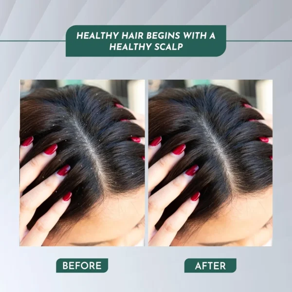Before and after using Botanical Hair Oil – healthy dandruff-free scalp